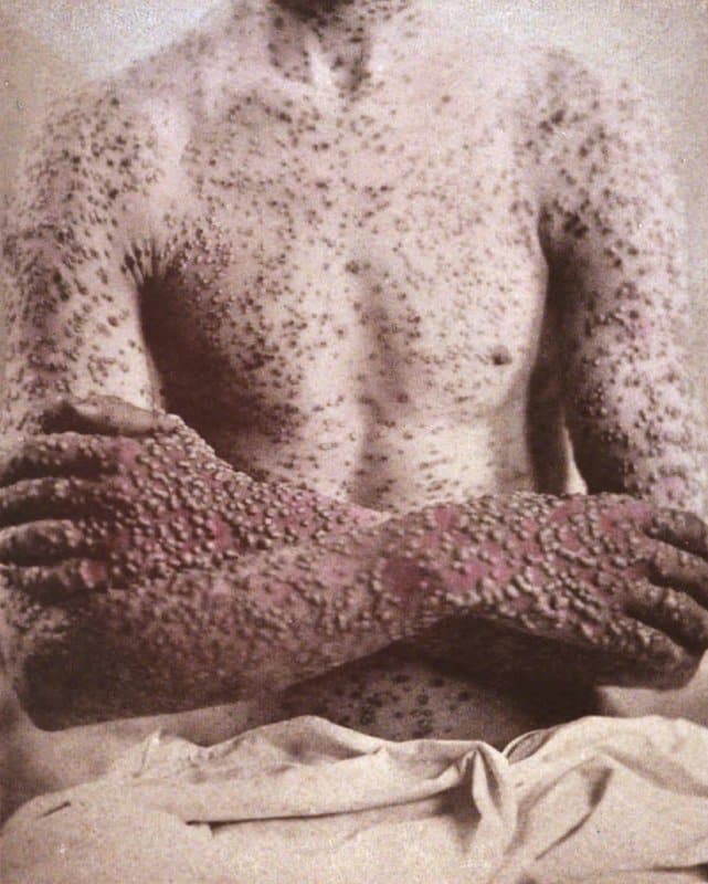 Viruela en un paciente de 1886